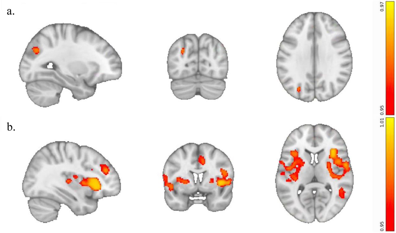 Thumbnail for The Role of the Dorsolateral Prefrontal Cortex in Ego Dissolution and Emotional Arousal During the Psychedelic State